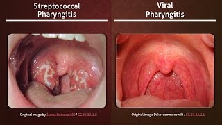 Streptococcal vs Viral Pharyngitis [upl. by Nomyar740]