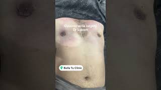 Gyno surgery before amp after [upl. by Hagep]