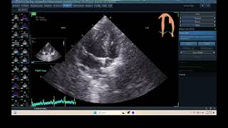 IQ 315 AUTOEF PYOMETRA ECHOPAC ANALYSIS ECHOCARDIOGRAPHY [upl. by Jocko657]