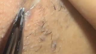 INGROWN HAIR REMOVAL 80  NEW PLUCK NOVEMBER 🍁 [upl. by Aleciram]