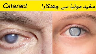 Cataract Treatment  Safed motiya  Homeopathic Treatment  Dr Tahir Aziz Zafar [upl. by Geller606]