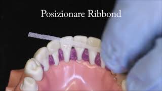 Ribbond Periodontal Splinting italian audio [upl. by Yaakov]