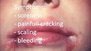 Angular Cheilitis Treatment permanent  How to Cure Angular Cheilitis in 12 hours [upl. by Aaron]