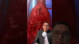 Aneurisma de aorta abdominal Parte 12 shorts drwilliamguerrero [upl. by Linzy376]