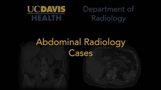 Medullary nephrocalcinosis on ultrasound [upl. by Eevets411]