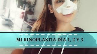 Mi rinoplastia  Día 1 2 y 3 [upl. by Anialed]