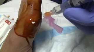 Gout and MTP Joint Arthrocentesis [upl. by Ardekahs]