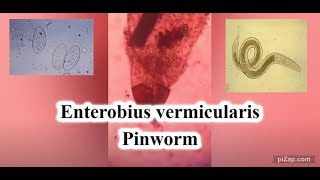 Enterobius vermicularis  Pinworm  Parasitology  pathCast [upl. by Adiahs34]