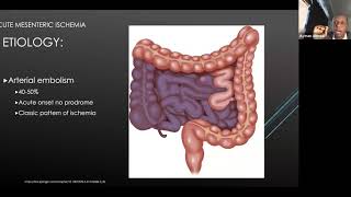 Mesenteric Ischemia [upl. by Assilem931]