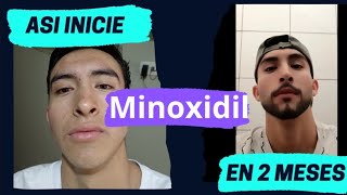 Usando Minoxidil 2 MESES [upl. by Annala]