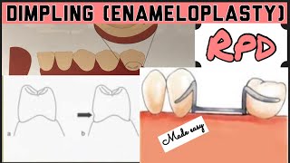 DIMPLING ENAMELOPLASTY II PROSTHETIC MOUTH PREPARATION II REMOVABLE PARTIAL DENTURE I PROSTHODONTICS [upl. by Jessen]