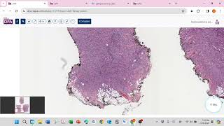 Dermatofibrosarcoma Protuberans DFSP [upl. by Akimahc]