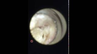 SUMMER SADNESS Swimmers Ear Otitis Externa  Dr Mike Lewis [upl. by Manda]