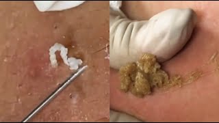 Most Satisfying Blackhead Removal Compilation Ultimate Extraction Videos [upl. by Cain]