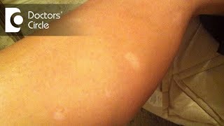 What causes sudden appearance of white round spots on legs  Dr Sudheendra Udbalker [upl. by Chrisse]