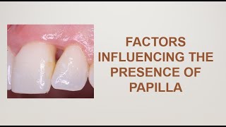 Papilla Reconstruction part 2 of 5 Factors influencing the papilla [upl. by Anjanette]