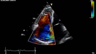 HUGE TRICUSPID REGURGITATION [upl. by Nnyltak]