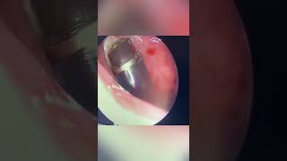 Removing Adenoids without bleeding or pain  Coblation Adenoidectomy [upl. by Stclair]