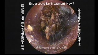 Regular cleaning of diffuse external auditory canal cholesteatoma 20241107 [upl. by Alrats468]