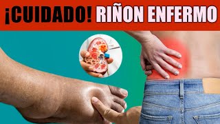 😮Síntomas de PROBLEMAS RENALES para PREVENIR Daños GRAVES [upl. by Rainer]