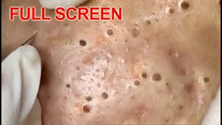 LARGE Blackheads Removal  Best Pimple Popping Videos [upl. by Nabroc136]