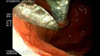 ENDOSCOPIC FUNDOPLICATION ESOPHYX TIF2 PART 1 CHRISTOS KARALIS MDwmv [upl. by Adekan]