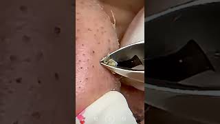 Skincare  Blackheads Removal 146 skincare skincare blackheads blackheads [upl. by Iret]