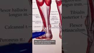 Insertional Achilles Tendonitis [upl. by Eatnwahs542]