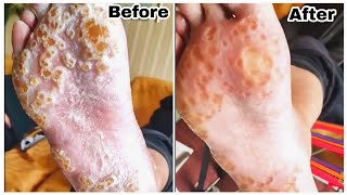 Callus Remove satisfyingsatisfyingvideo shorts diy callusremovalcallusremover footcarecr7 [upl. by Kcirdor37]