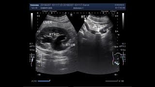 Ultrasound Video showing a stone in ureter [upl. by Weismann808]