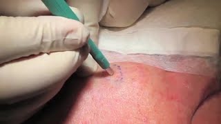 Punch Biopsy  Professor David Wilkinson  Professional Certificate of Skin Cancer Medicine [upl. by Rapp]