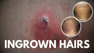 What are Ingrown hairs How to get rid of ingrown hairs [upl. by Elmaleh]