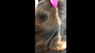 EXTREME HEAD LICE REMOVAL [upl. by Jollenta]