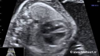 Fetal heart Academy  TGA 2 four chamber view [upl. by Gardol]