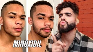 Evolução dos INSCRITOS  MINOXIDIL 🧔 [upl. by Yekcaj]