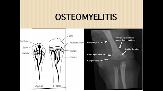 Acute Osteomyelitis [upl. by Anim9]