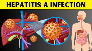 Hepatitis A Infection  Signs amp Symptoms Risk Factors Virology Diagnosis And Treatment [upl. by Genovera624]