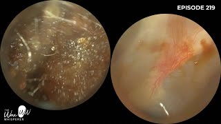 220  Difficult Ear Wax Removal in Narrow Ear with the WAXscope [upl. by Melan]