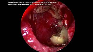 Fungal ball in Sphenoid sinus with erosion of skull base [upl. by Peacock54]