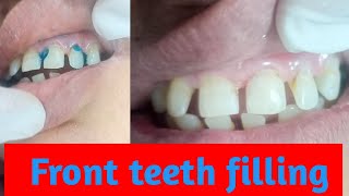 front teeth cavity fillings [upl. by Oibaf807]