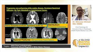 Dr Manzoor Ahmed l Adult Onset Leukodystrophy [upl. by Corabelle]