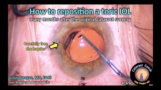 CataractCoach 1650 how to reposition a toric IOL [upl. by Ybbil269]