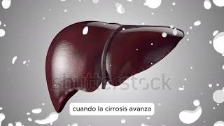 CIRROSIS HEPÁTICA [upl. by Nairolf]