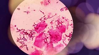 Candida albicans introduction morphology pathogenesis lab diagnosis and treatment [upl. by Adnilreb]