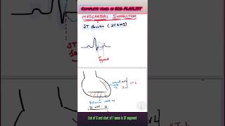 Myocardial infarction ❤️HOW TO IDENTIFY ECG ‼️ HOW TO TREAT ‼️ [upl. by Eneryc274]