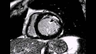 Cardiac MRI  LCx territory subendocardial infarction [upl. by Stoeber]