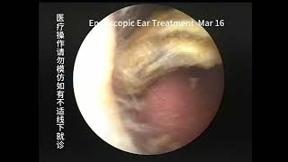 Regular cholesteatoma reexamination and cleaning of the ear [upl. by Lak]