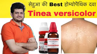 सेहुआ की Best Homeopathic Medicine  Tinea versicolor Remove Combination  How to Use [upl. by Einnal]