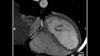 Cardiac Right Coronary Artery 4 of 7 [upl. by Aicala]