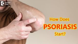 How does psoriasis start Main Causes amp Symptoms  Dr Chaithanya K S  Doctors Circle [upl. by Farnham]